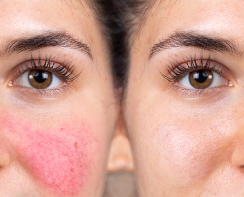 rosacea vs eczema
