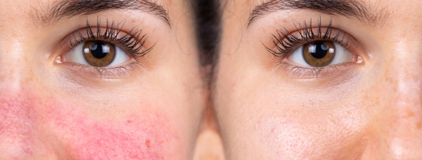 rosacea vs eczema