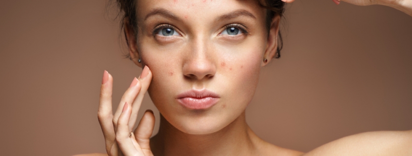 skincare for acne