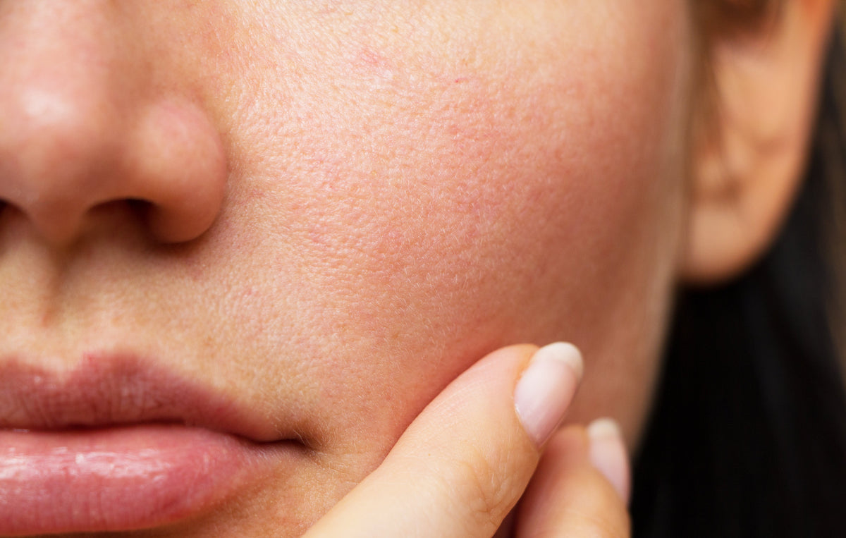 Rosacea Relief: Expert tips and products to calm and treat skin