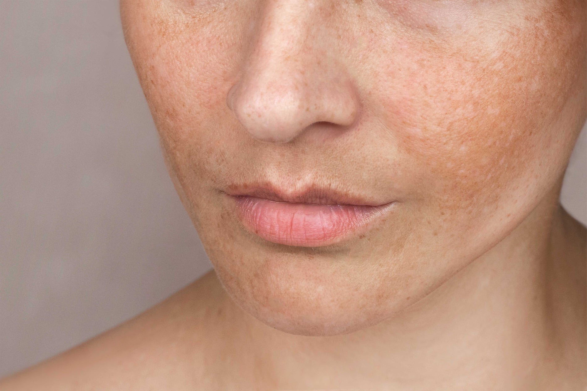 Hyperpigmentation: The causes and the best treatments