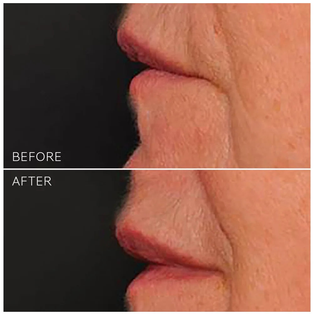 Before and after comparison of a person's lips with visible skin texture after use of VIE COLLECTION Hydra Volume Lip Plumping Serum.