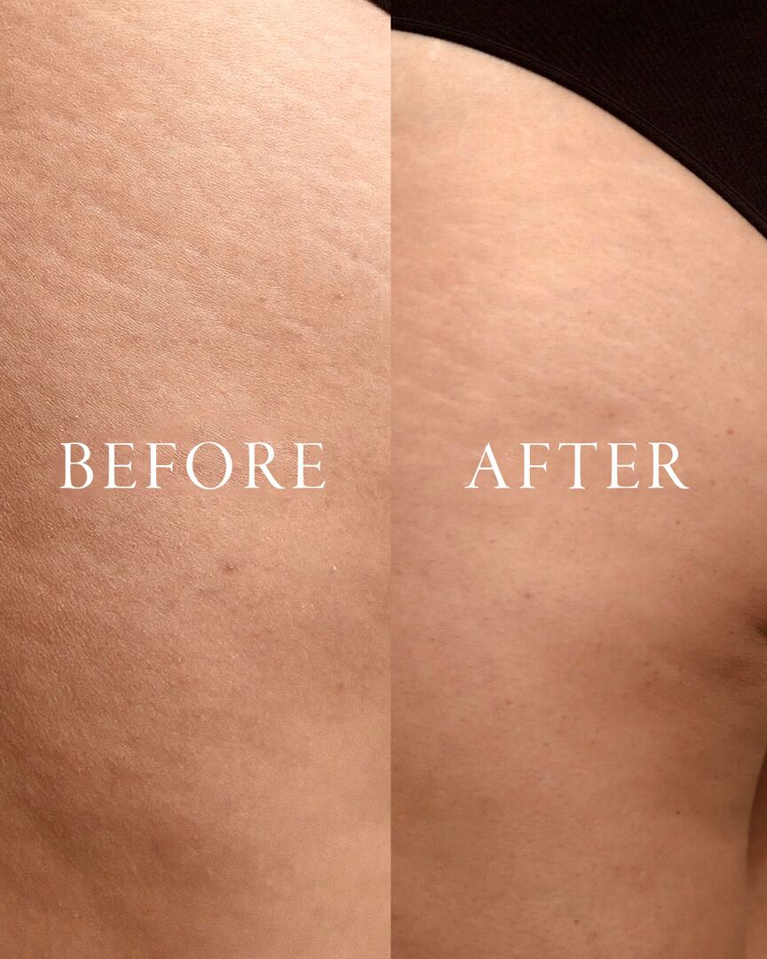 Before and after comparison of skin texture on a person's arm after using PHYTOMER Celluli Attack Concentrate