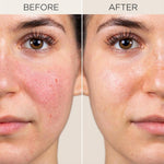 Before and after comparison of a person's face with visible skin improvement.
