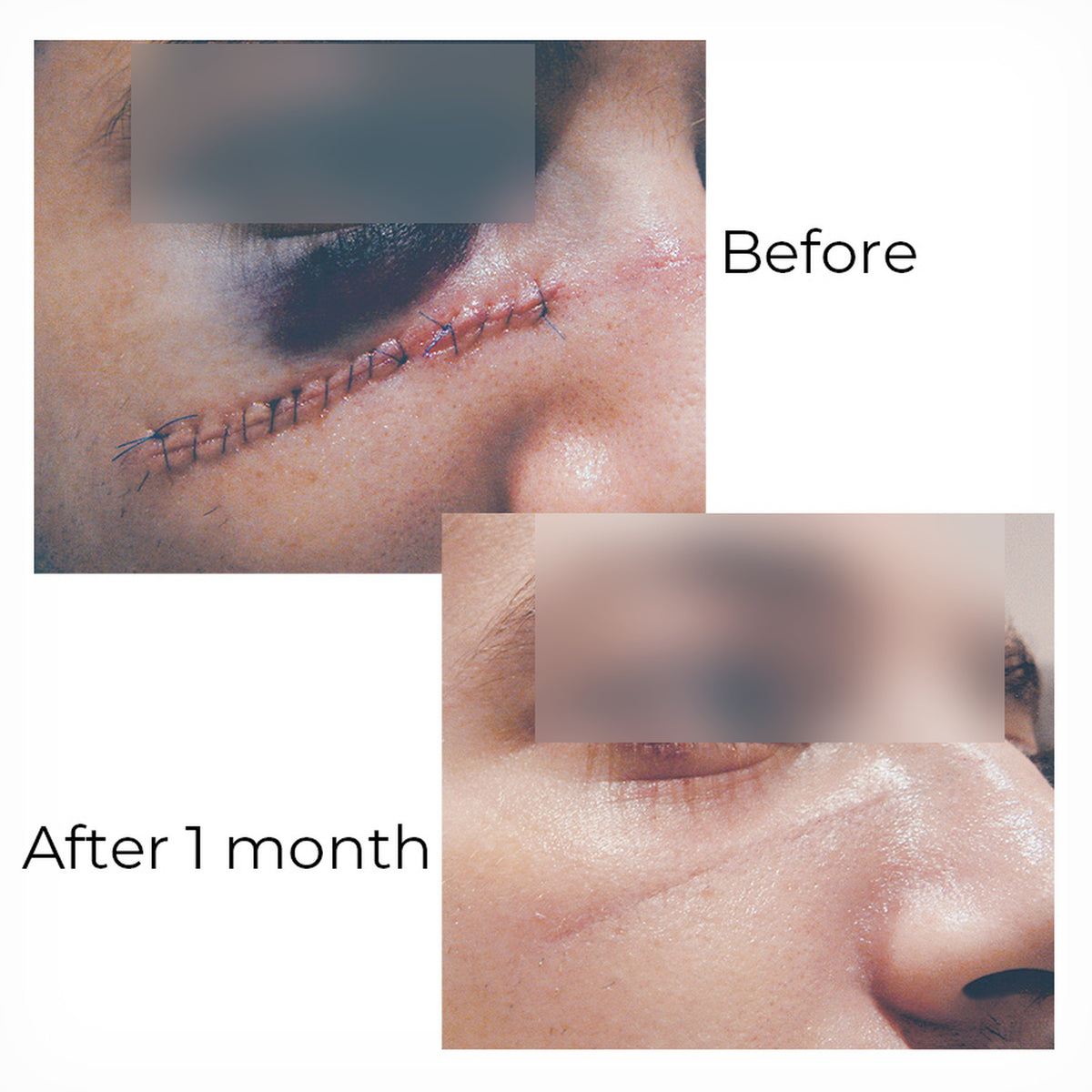 Privacy protected before and after scar healing image showing wound and healed stage after one month
