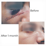 Privacy protected before and after scar healing image showing wound and healed stage after one month
